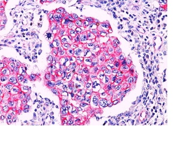 FFPE breast carcinoma, ductal sections stained with 100 ul anti-beta-Catenin (clone Polyclonal) at 1:200. HIER epitope retrieval prior to staining was performed in 10mM Tris 1mM EDTA, pH 9.0.